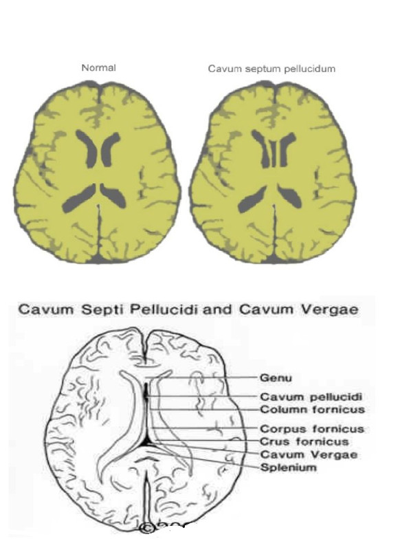 Figure_Septum Pellucidum, Cavum Pellucidum, Cavum Vergae-final