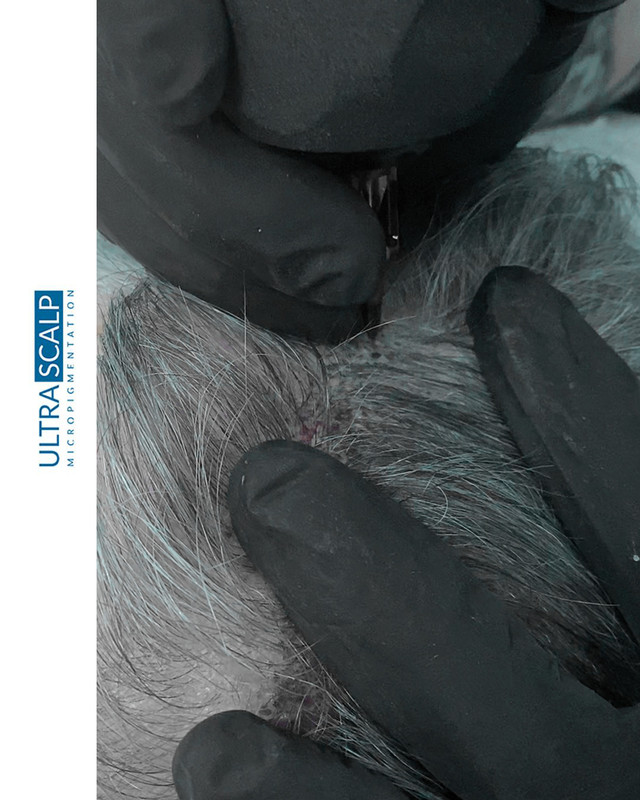 Scalp Micropigmentation Tampa