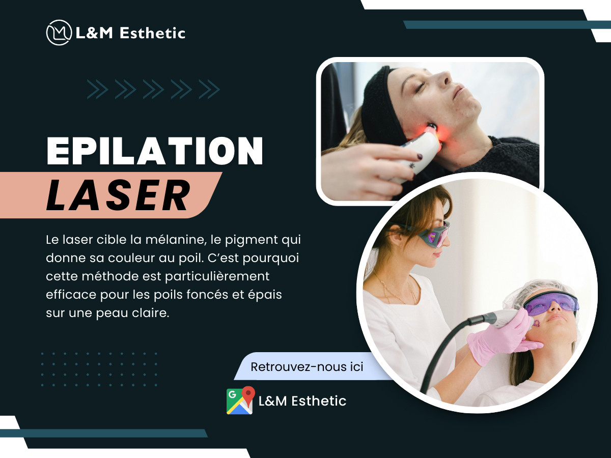Epilation Laser