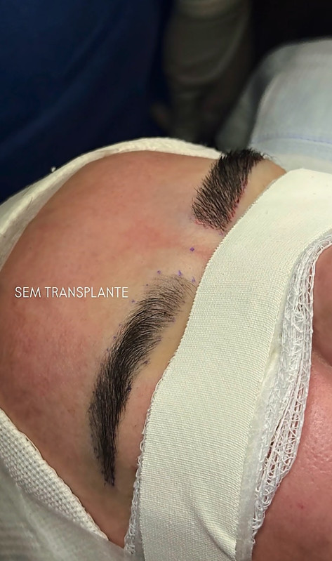 Resultado de transplante de sobrancelhas 5