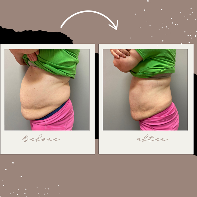 Body Sculpting Results