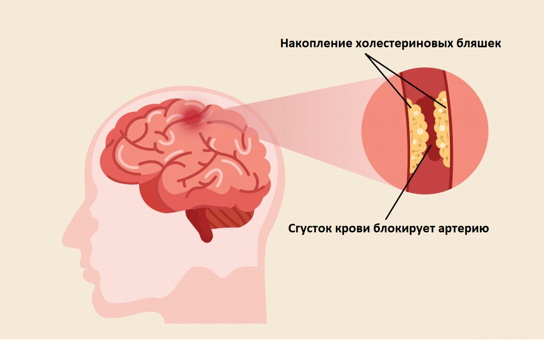 Лечение церебрального атеросклероза головного мозга. Церебральный атеросклероз. Атеросклероз сосудов головного мозга. Церебральный атеросклероз сосудов головного мозга симптомы. Атеросклероз церебральных артерий.