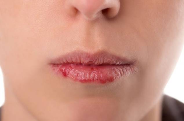 Что делать, если потрескались губы. Лечение губ в домашних условиях