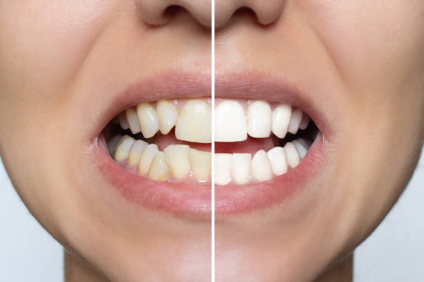 Dental Veneers Comparison