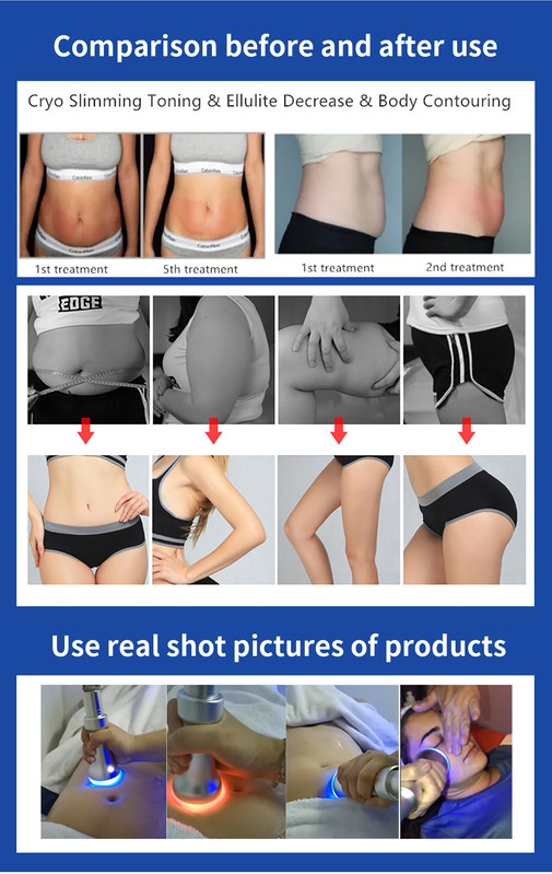 Real before and after results: abdomen, arms, thighs, buttocks