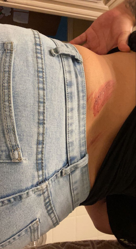 Injury on lower back