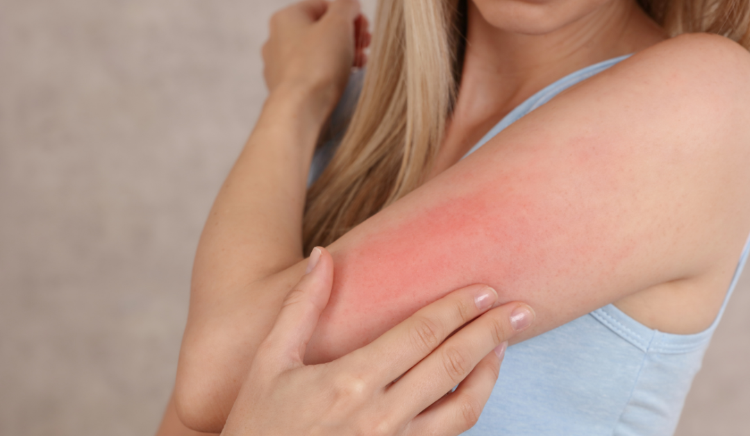 Preventing Skin Allergies