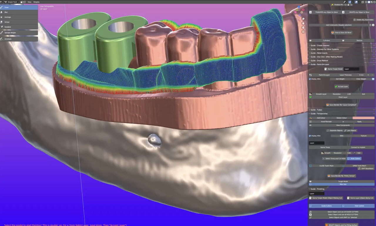 Análisis digital de implante dental
