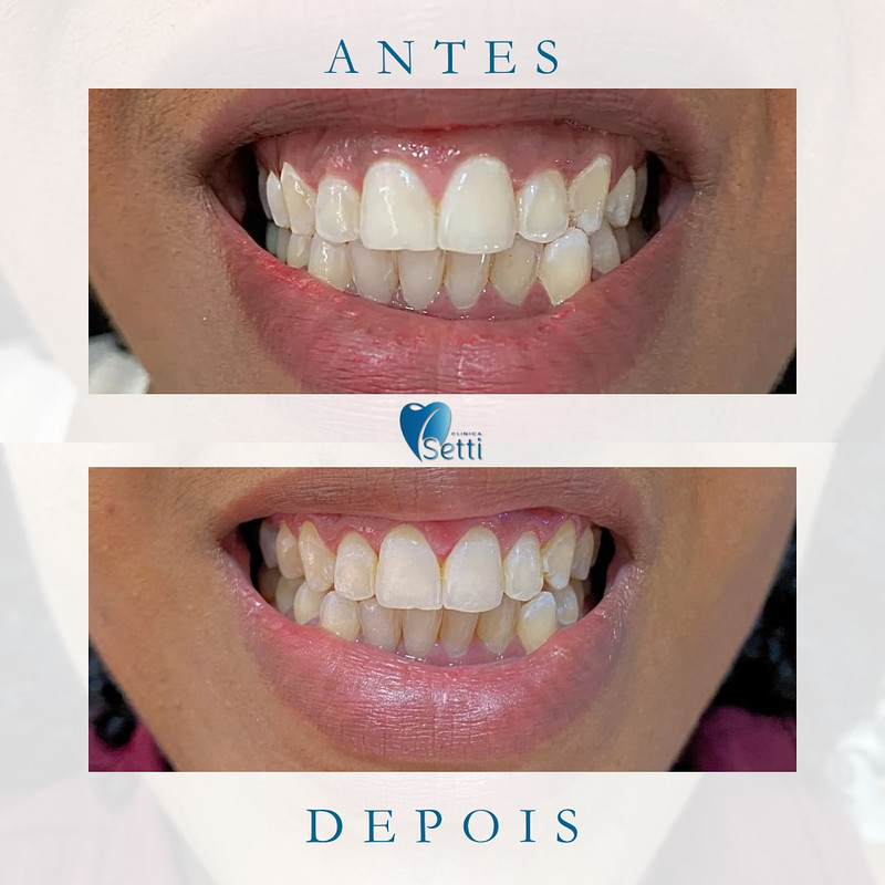 Resultado 1 - Lentes e Facetas Antes e Depois Integrado