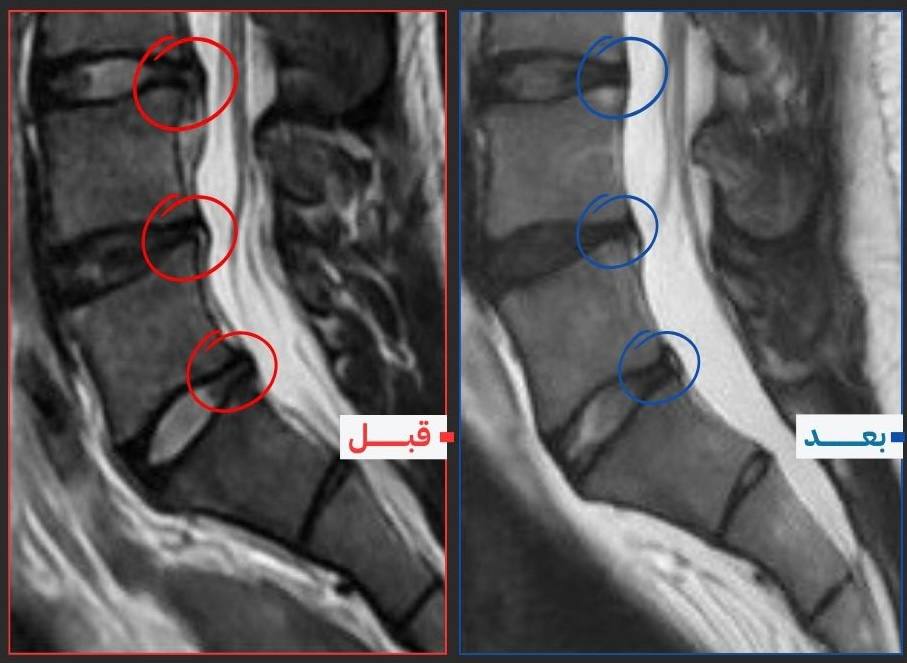 صورة رنين مغناطيسي قبل وبعد العلاج