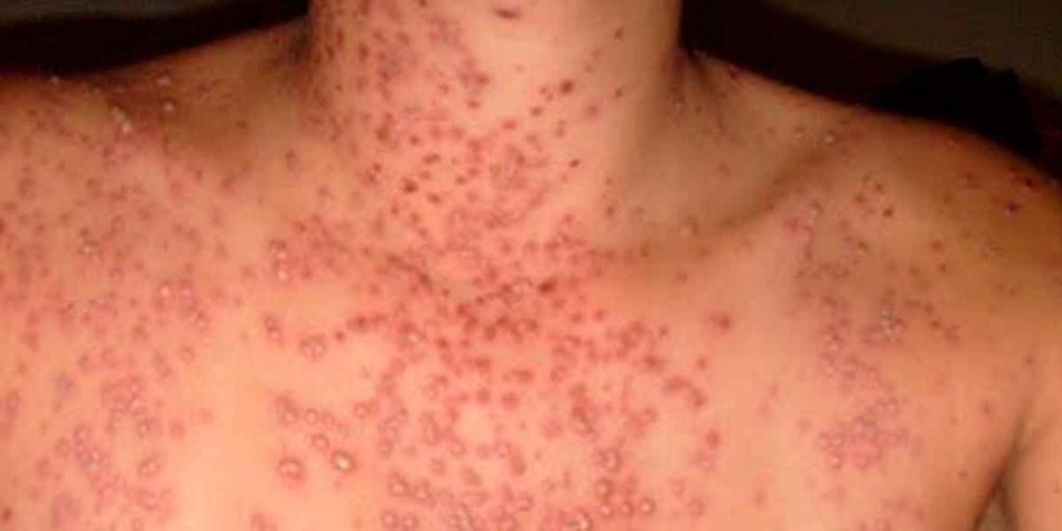 Francia abrirá un centro de vacunación contra viruela del mono en París