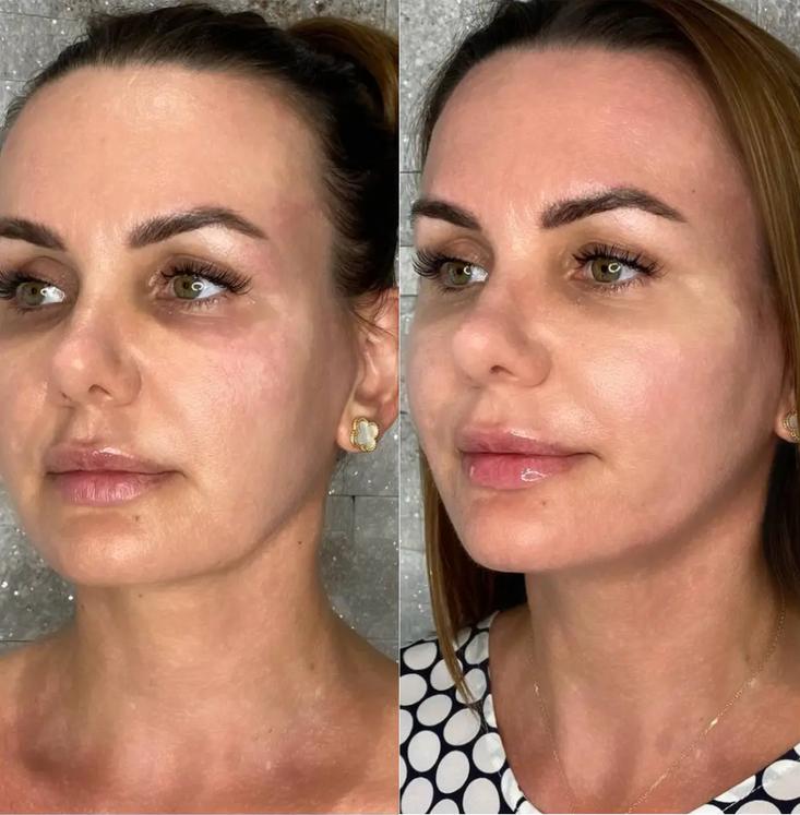 PDO thread treatment results at Let's Face It Med Spa in Denver.