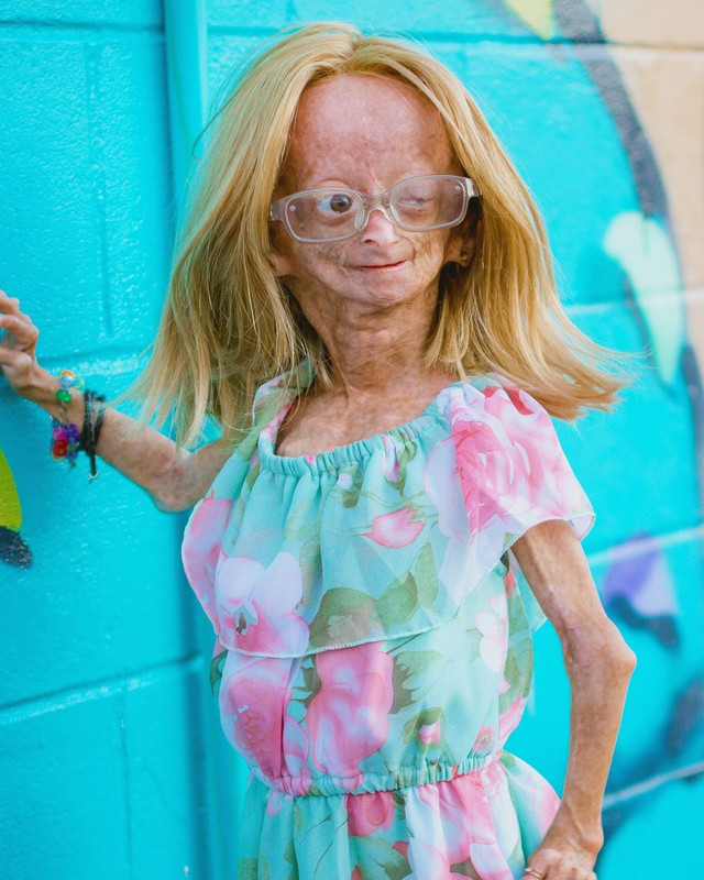 Adalia Rose kini sudah berusia 14 tahun