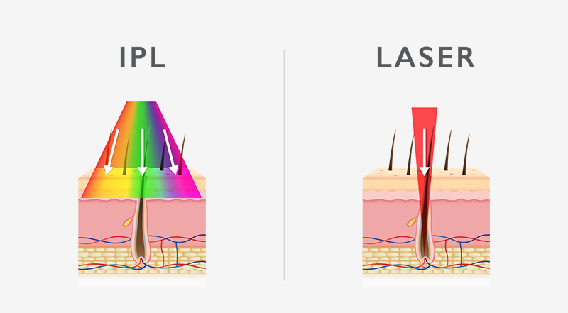 Laser for Hair Removal vs Intense Pulsed Light