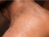 Skin After Treatment
