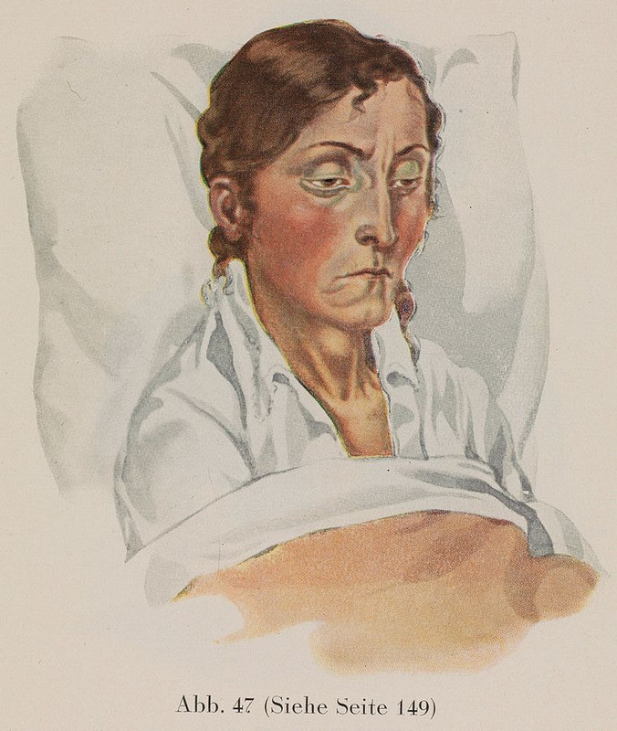 Woman-Suffering-From-Pneumonia-Baumgartner.jpg