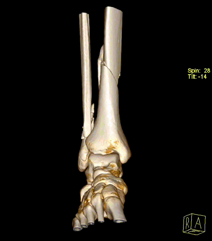 18 12 25 gleženj d vrt range 3 edit
