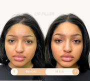 Lip filler before and after result