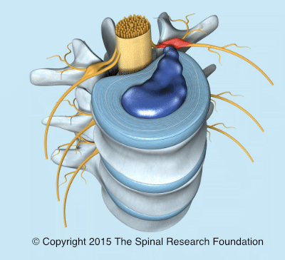 https://i.postimg.cc/K8GZF4bz/Nerve-Root-Signature-Pain400.gif