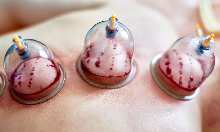 Hijama Therapy