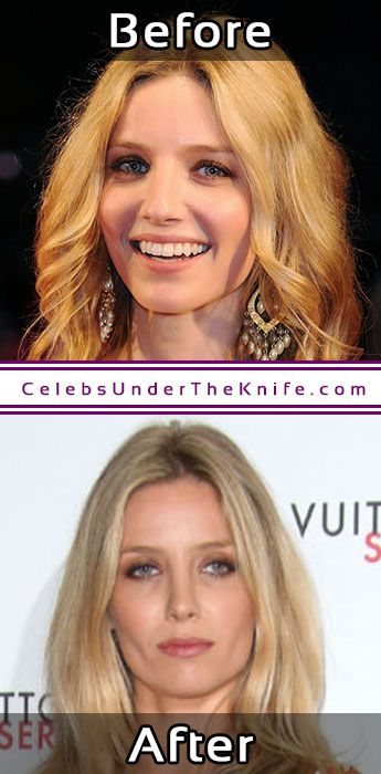 00-08-56-Annabelle-Wallis-Cosmetic-Procedure-Results