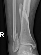 18 12 25 gleženj ap d 1