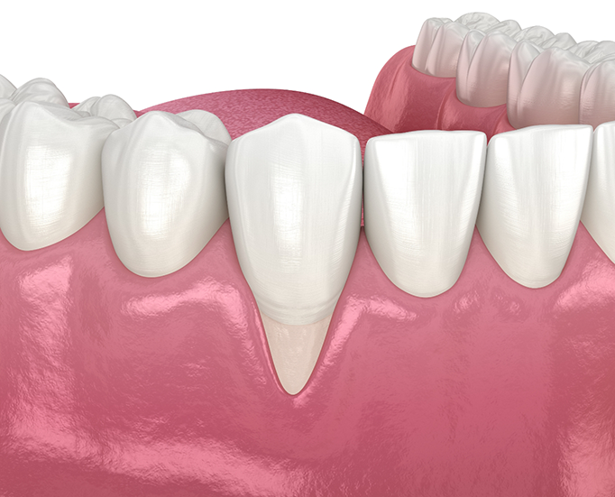Should You Get an Exposed Tooth Root Filling When Gum Recession Appears?