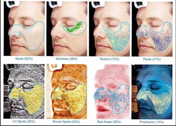 VISIA complexion analysis showing different measurable skin features