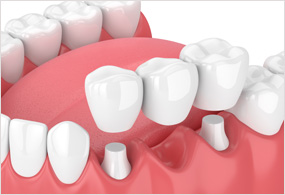 Crown & Bridge Treatment
