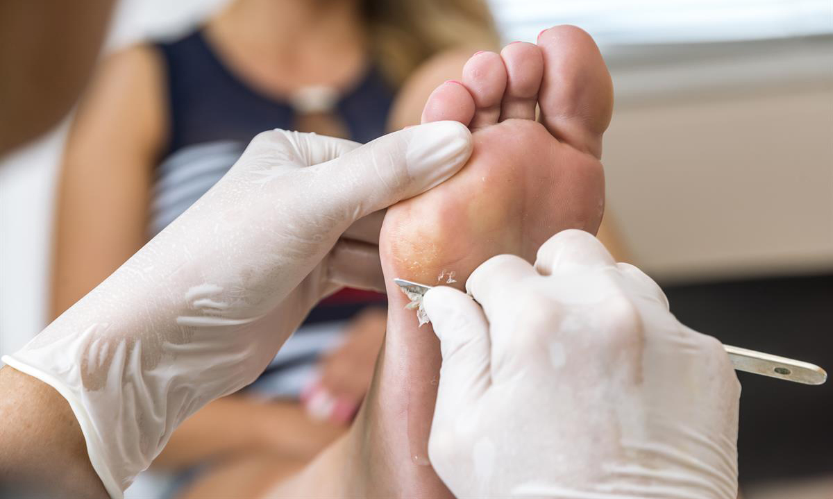 Tratamiento de onicomicosis