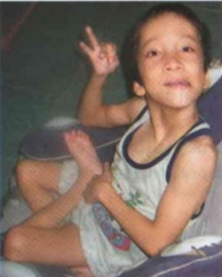 Clinical photograph showing sustained abnormal posture with twisting movements characteristic of dystonia