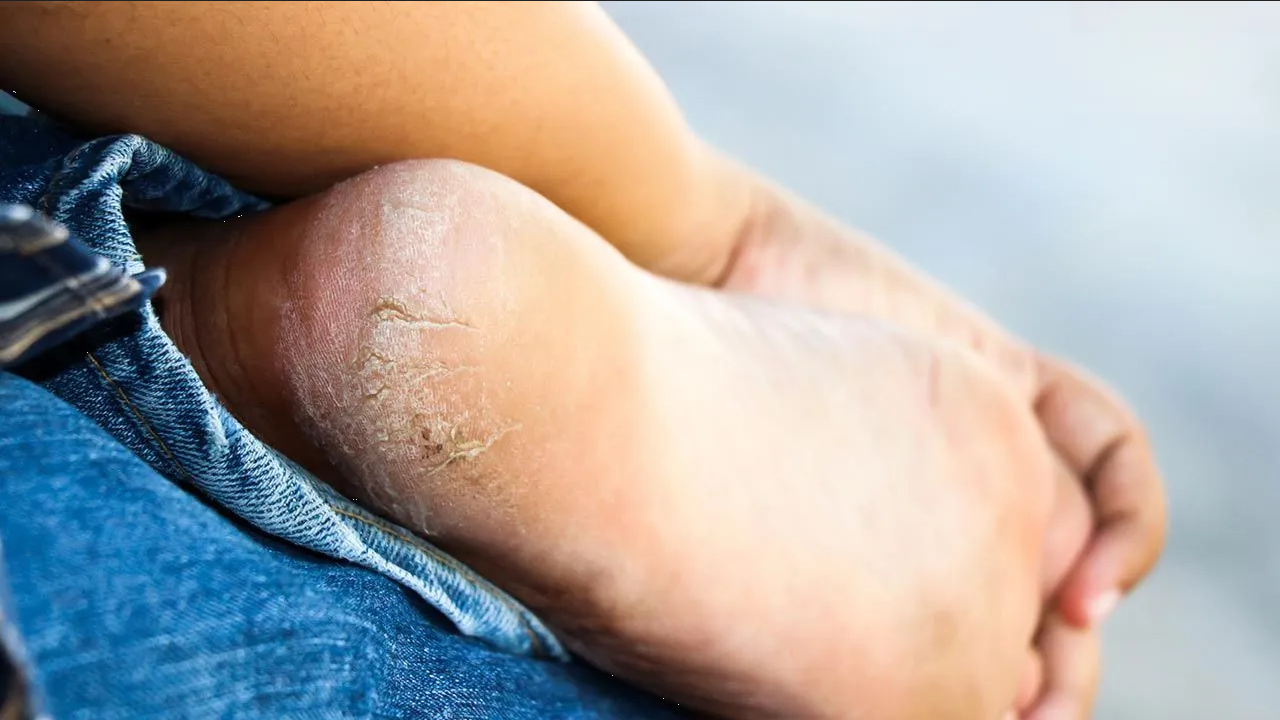 Aplica esta crema casera para pies, así eliminarás los talones agrietados