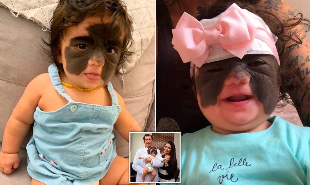 Niña con marca de Batman en la cara fue operada con éxito y luce su nuevo rostro