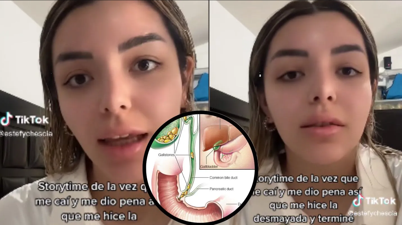 Fingió desmayarse y le quitaron la vesícula, conoce la anécdota que circula en Tiktok