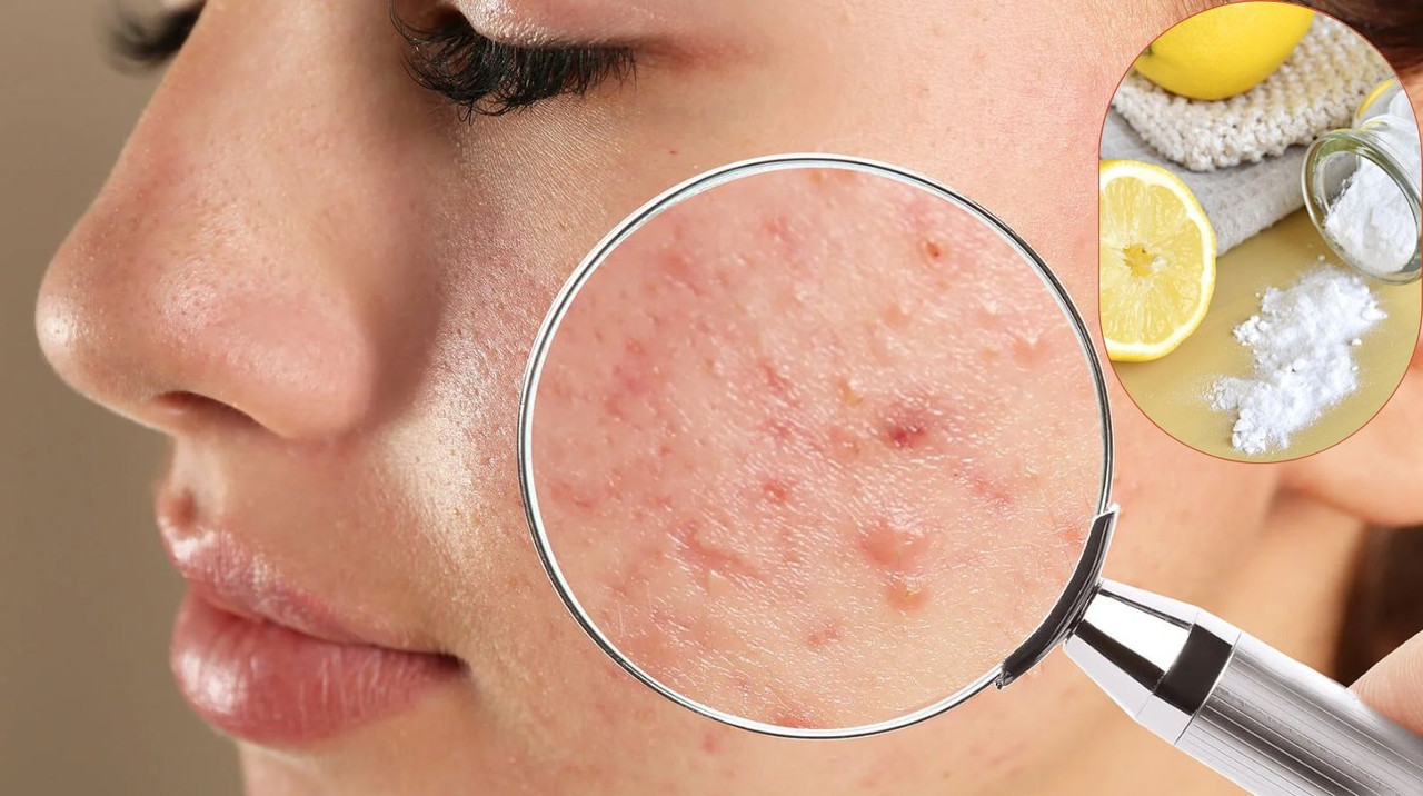 Remedios caseros para el acné