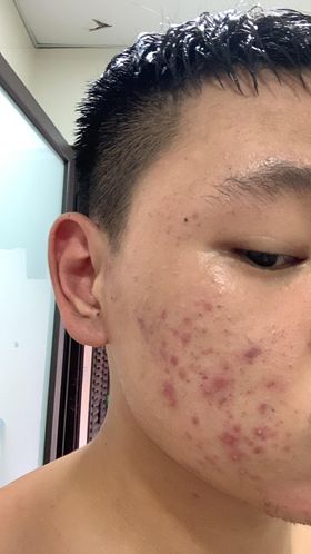 serum trị mụn thâm