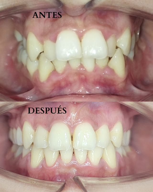 Antes y Después