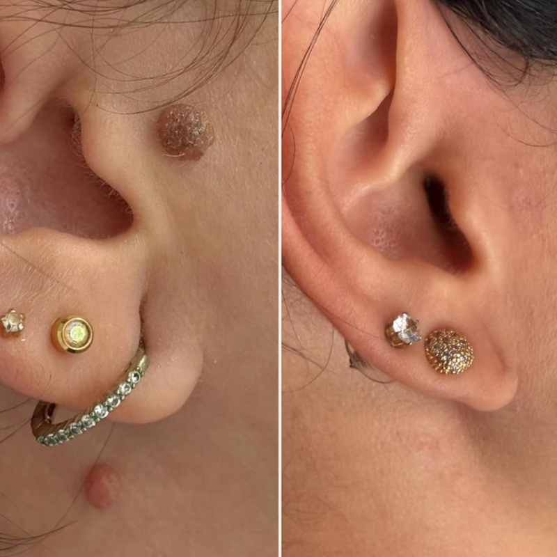 Remoção de Pintas e Verrugas