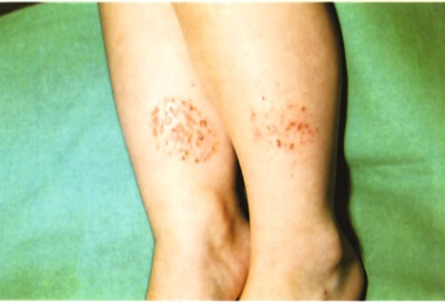 Clinical photograph showing coin-shaped (nummular), erythematous, crusted plaques on the extensor surface of the arm, characteristic of nummular eczema