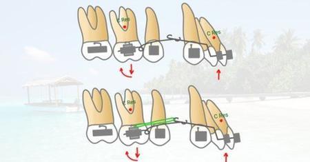 Orthodontic Treatment in the Early Permanent Dentition