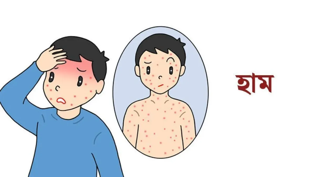 সিলেটে হামে আরও ২ শিশুর মৃত্যু, মৃতের সংখ্যা ২০২