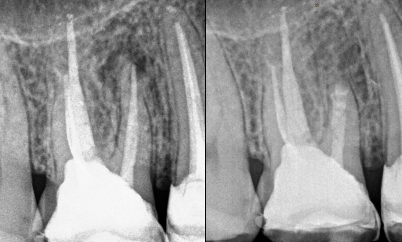 Cirugía Apical