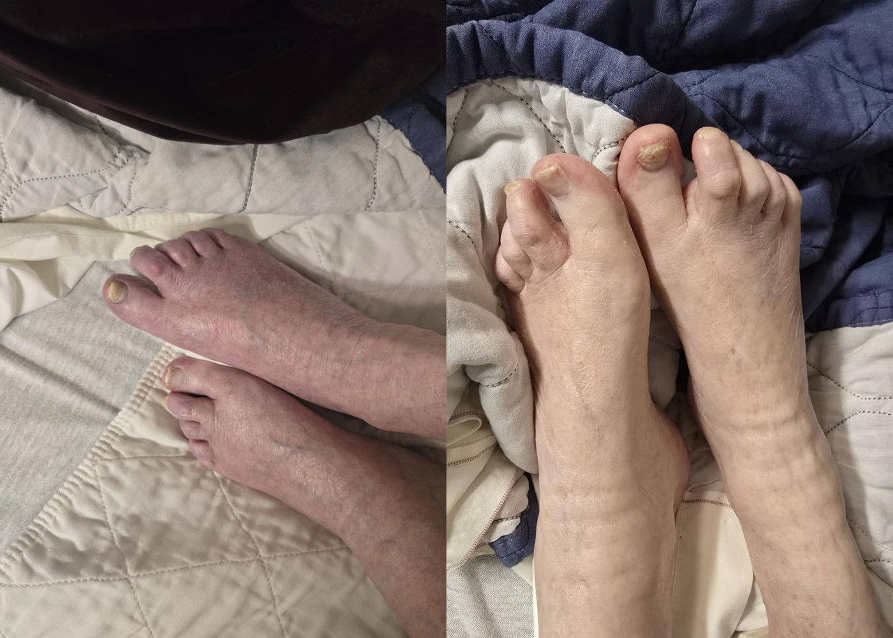 Antes e depois cliente creme para varizes