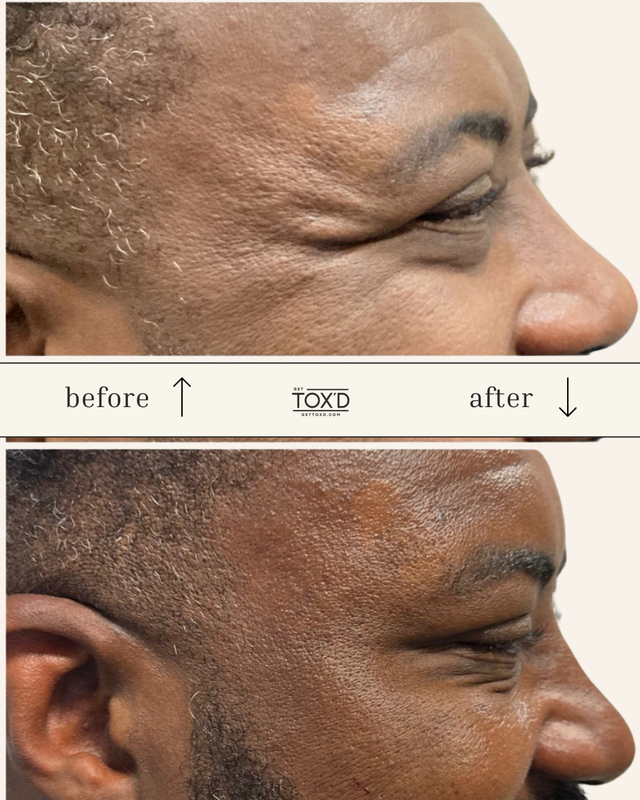 Brotox (Botox for men)