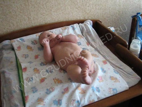 Синдром мышечной дистонии до массажа ребенка (3 месяца)