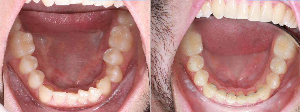 invisalign avant apres