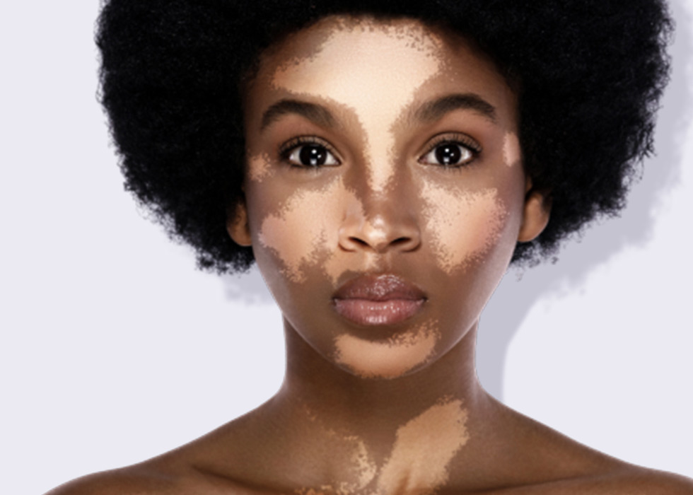 Vitiligo and pigmentary disorders