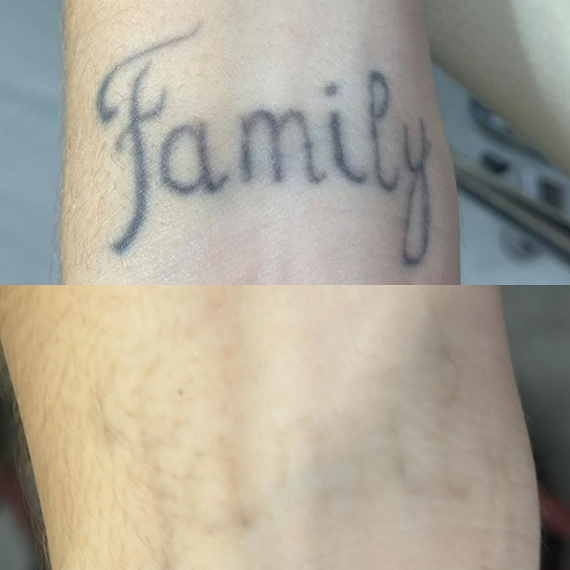 Remoção de Tatuagem
