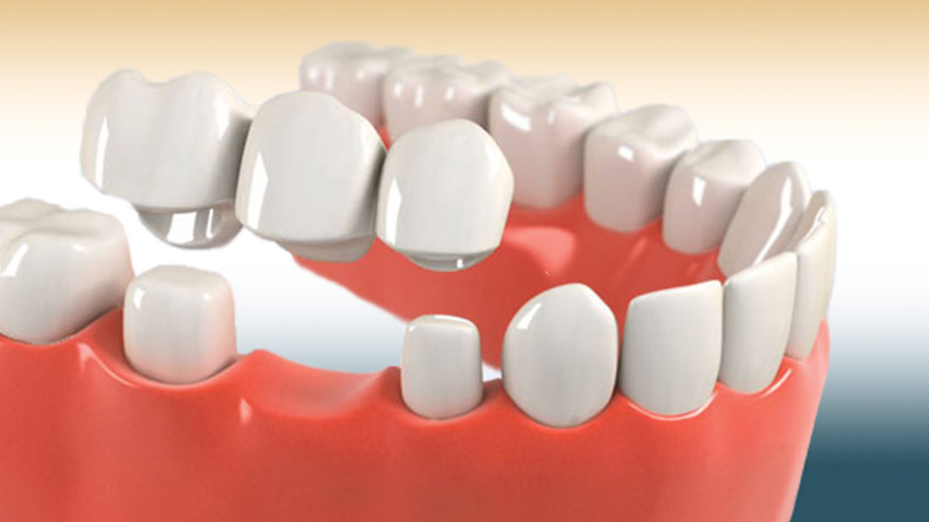 Crown and Bridge (Zirconia, PFM, E-max)