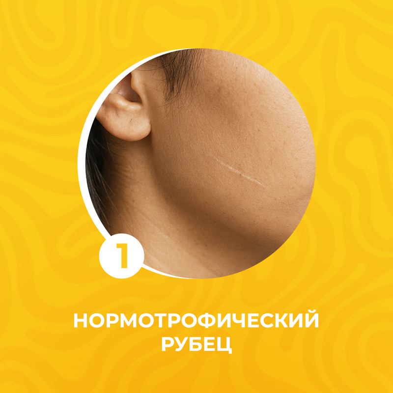 Нормотрофический рубец